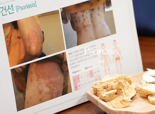 생기한의원으로 보는 건선 진료 항목과 관련 정보 안내